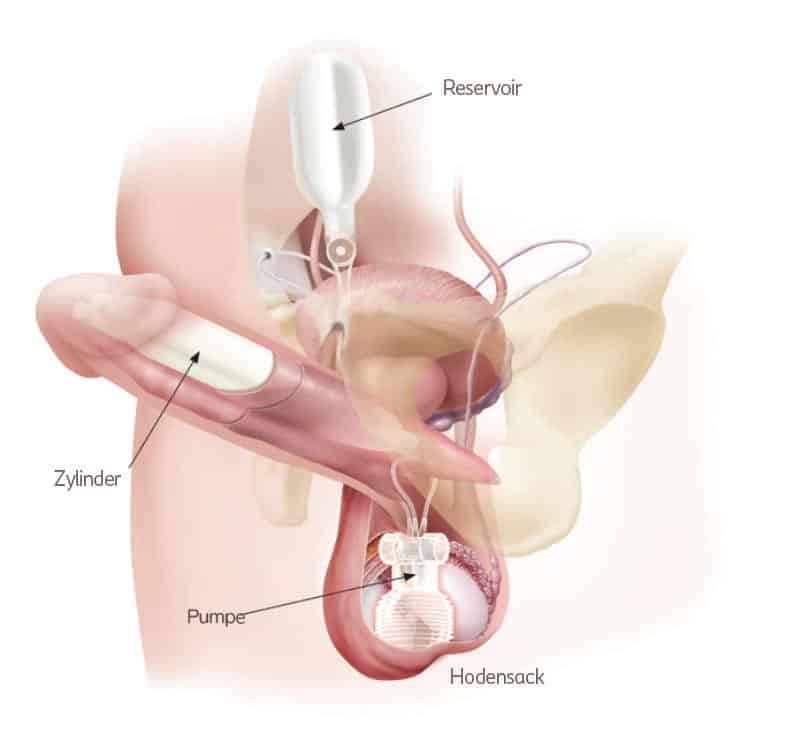 Aufpumpbare-penisprothese-anatomie-darstellung